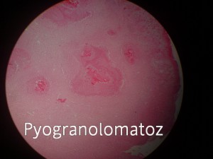 Pyogranolomatosis