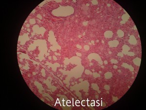 آتلکتازی (Atelectasis)