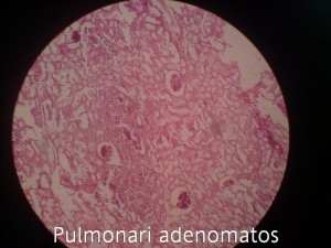 آدنوماتوز ریوی(Pulmonari Adenomatosis)