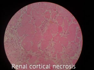 Renal cortical necrosis