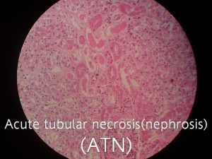 Acute tubular necrosis